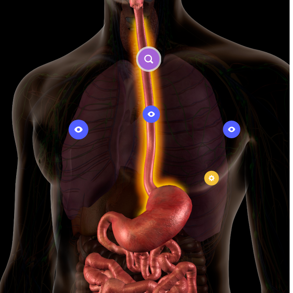 Пищевод Баррета
