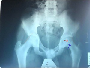 507_left SCFE_pelvis